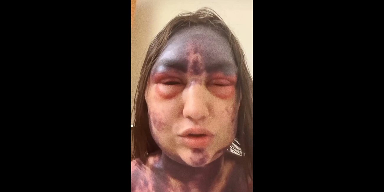 Alexis Lorenze UCI Health Vaccine Injured Girl Update