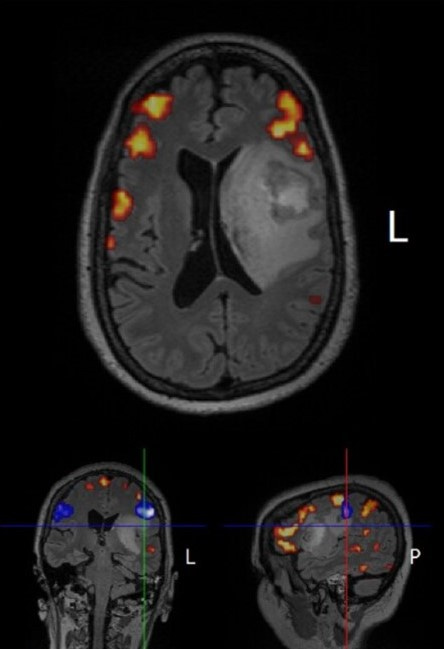 Mission GBM | Scott L. Rakestraw, PhD | Substack