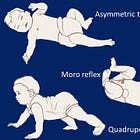 Primitive Reflexes and Their Role in Chronic Pain and Muscle Tension Issues