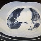 Steroids for severe pulmonary infections: Review