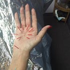 Exploring Alternative Treatments: Acupuncture