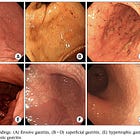 Endoscopic Diagnosis of Gastritis Is Difficult