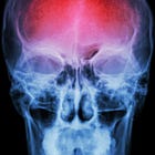 SHOCKING Study: Spike Protein Found in Stroke Victims’ Brains Up to 17 Months After Injection