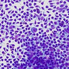 Literature Review: T-Zone Lymphoma