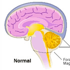 Neurological Manifestations of EDS