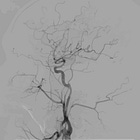 Thrombectomy proves beneficial for the largest ischemic strokes, too (LASTE trial)