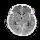 Blood transfusion targets in acute brain injury: Review