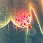 ¿Cómo se trata un cáncer de mama?