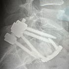 The art of running 100 miles on a busted spine