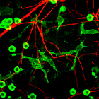 Parkinson's Disease after Pfizer jabs most likely due to Endotoxin in every vial