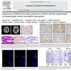 BREAKING STUDY — COVID-19 mRNA Injection Spike Protein Expressed in Cerebral Arteries of Stroke Patients for Up to 17 Months