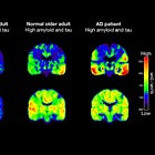Should You Be Checking the New Blood Test For Alzheimer’s?