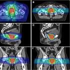 Protons 101: The COMPARRE Trial - Proton vs. IMRT for Prostate Cancer