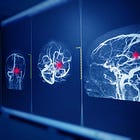 Thrombectomy after large ischemic strokes: worth the risk?