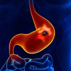 Stress ulcer prophylaxis in the ICU: Review