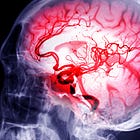 Should thrombolytics be given >4.5 hours after stroke onset?