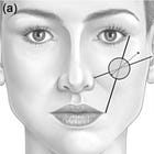 Por onde iniciar os tratamentos de Preenchimento Facial? 