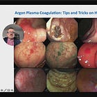 Argon Plasma Coagulation