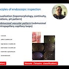 Basic Principles of Endoscopic Inspection - Yao Classification