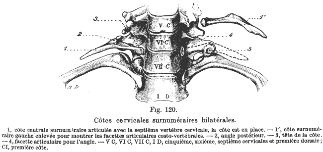 Cervical Ribs