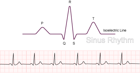 Sinus Rhythm - Normal Function of the Heart - Cardiology Teaching Package -  Practice Learning - Division of Nursing - The University of Nottingham