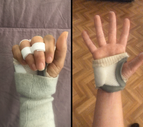 A progress video two weeks apart of a broken hand demonstrating range of motion in a protective glove.