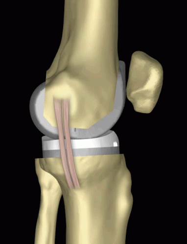 Knee Articulate Joint GIF - Knee Articulate Joint Bones - Discover & Share  GIFs