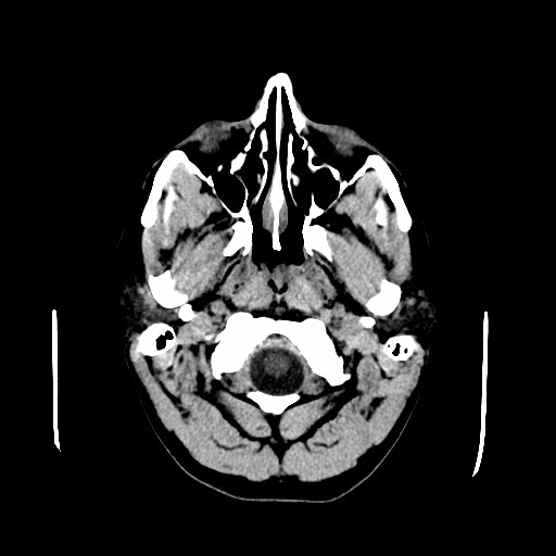 File:Colloid Cyst Cat scan GIF.gif