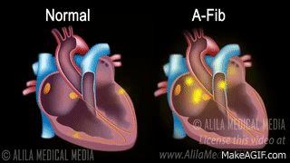 Atrial Fibrillation Anatomy, ECG and Stroke, Animation. on Make a GIF Atrial Fibrillation Anatomy, ECG and Stroke, Animation. on Make a GIF