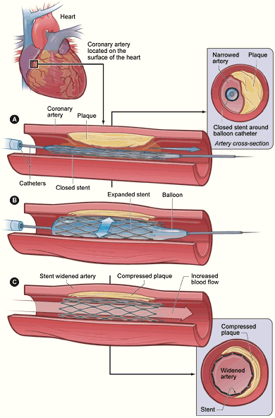 PTCA stent NIH - PICRYL - Public Domain Media Search Engine Public Domain  Image