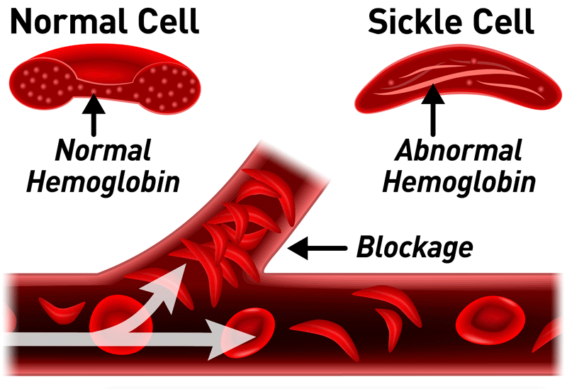https://steemitimages.com/DQmPxzfUfbxkw4SqqQBvPAYe3CJwPvzK234VyqEv74zc83E/Sickle-Cell-Normal-Cell_800x549.gif