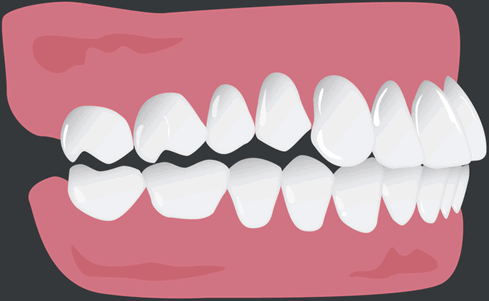 Posterior Open Bite – ClearCorrect Support