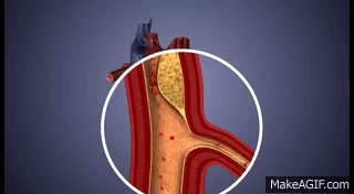 Atherosclerosis - 3D Animation || ABP © on Make a GIF