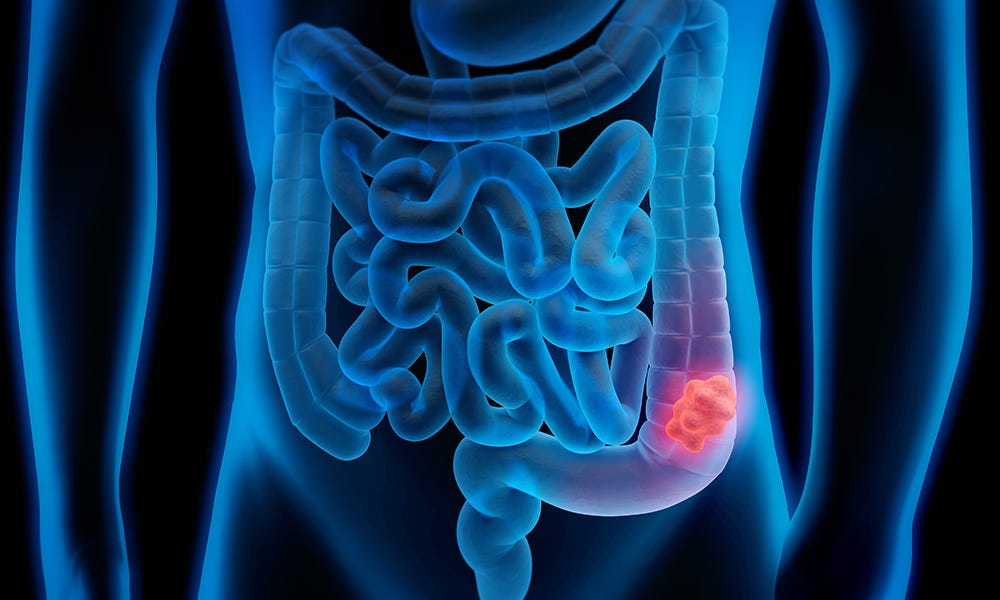 Colon-Cancer-Illustrated-Feature-DTM