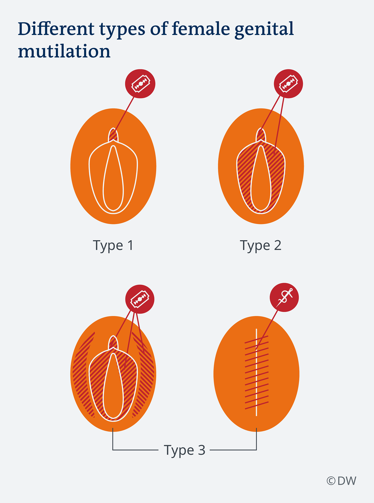 illustration of the four stages of FGM