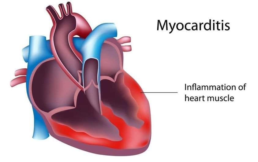May be an image of text that says "Myocarditis Inflammation of heart muscle"
