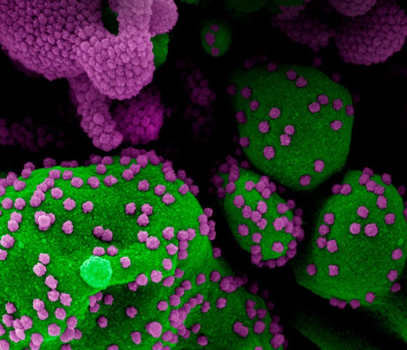 Micrografia elettronica a scansione colorata di particelle di coronavirus SARS-CoV-2