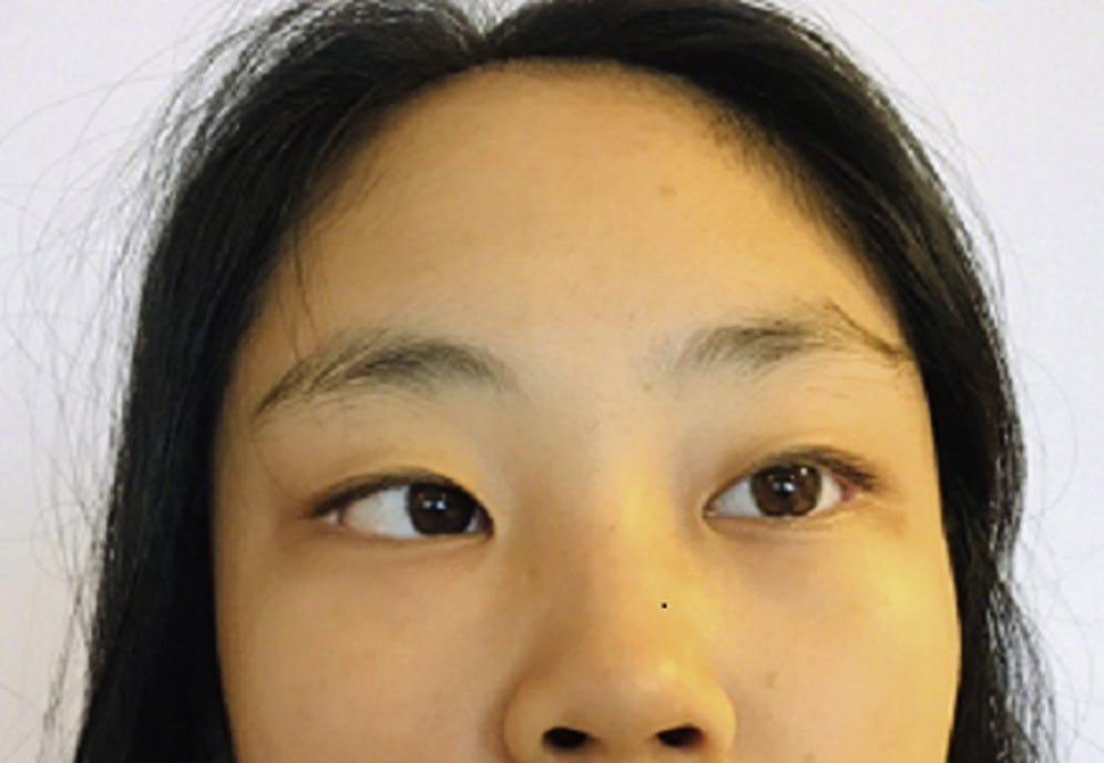 A 15-Year-Old Girl with a Squint - The Journal of Pediatrics