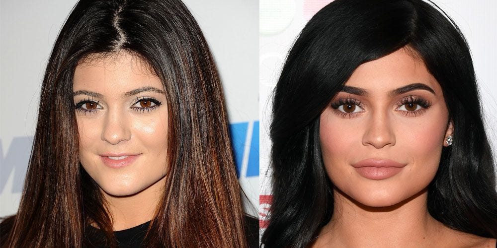 Plastic surgery before and after - 9 celebrities on what it's really like