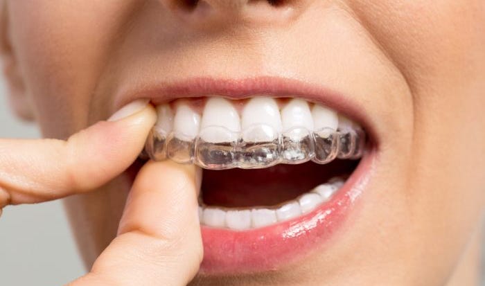Can You Fix An Overbite With Invisalign? - Fine Orthodontics BlogFine  Orthodontics Blog