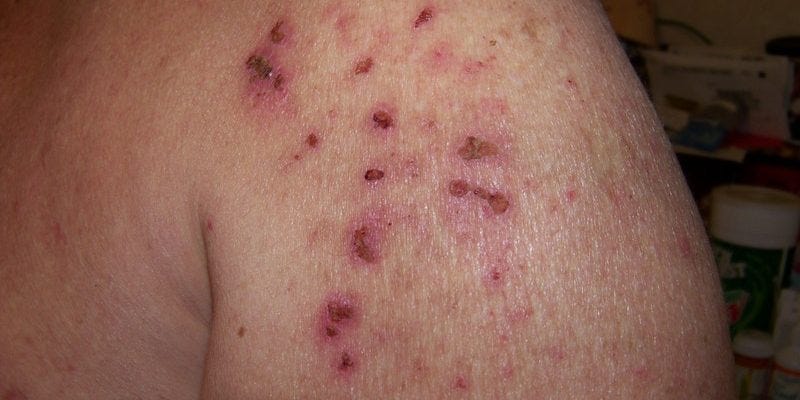 Morgellons Disease Causes, Signs and Symptoms