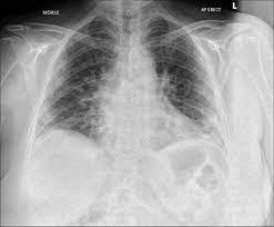 COVID-19 pneumonia | Radiology Case | Radiopaedia.org