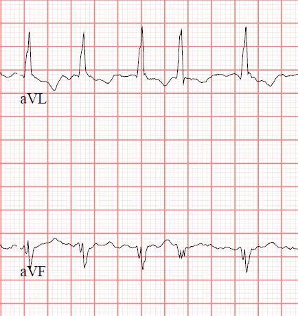 Atrial Fibrillation in two leads.jpg