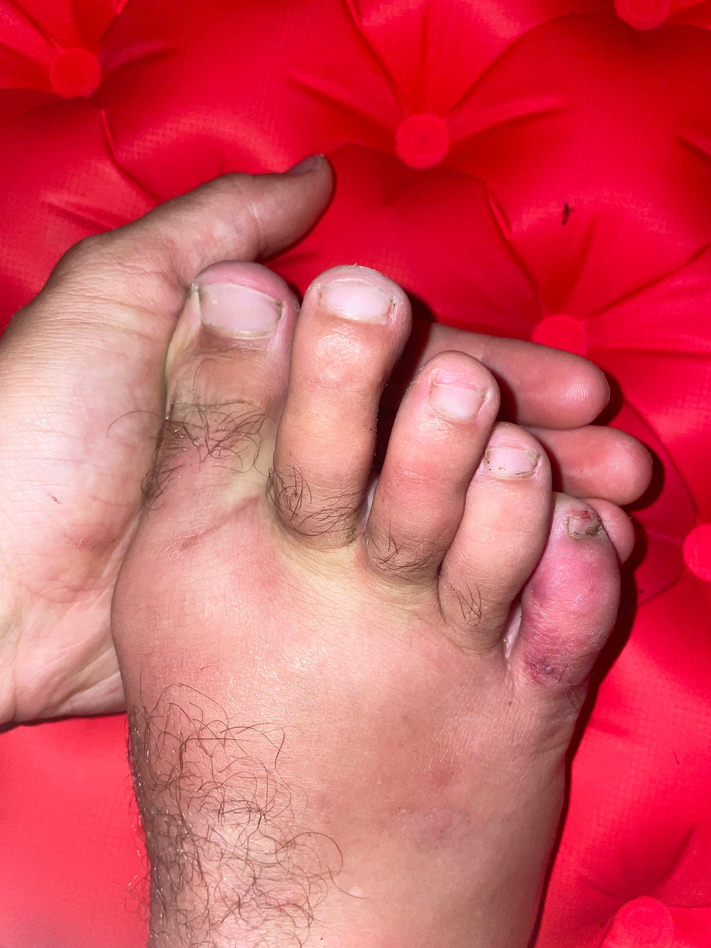 Colton’s swollen foot with spider bite on his baby toe