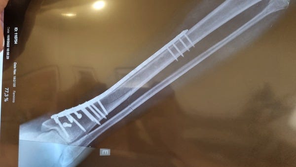 Raio X mostrando a mesma perna com os ossos alinhados, dessa vez com uma placa de titânio e 17 parafusos