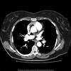 CT lung cancer screening