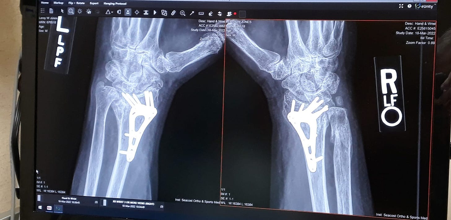 X-Ray of broken bones with metal plates.