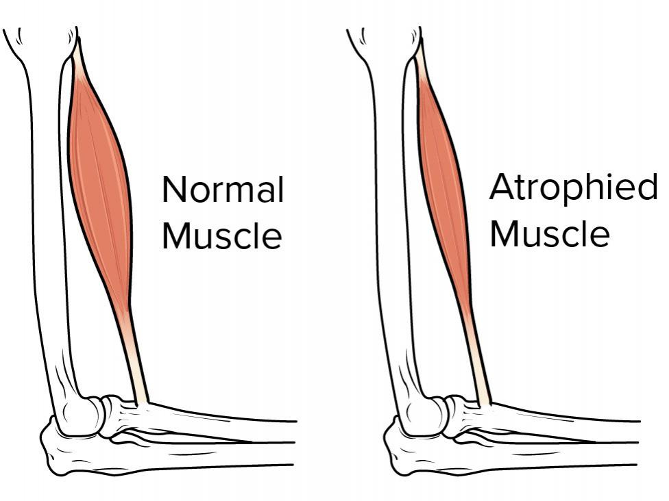 Muscle atrophy: Causes, symptoms, and treatments