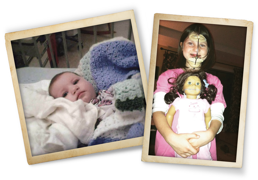 Mia as a baby after surgery, and Mia wearing her headgear while holding a doll