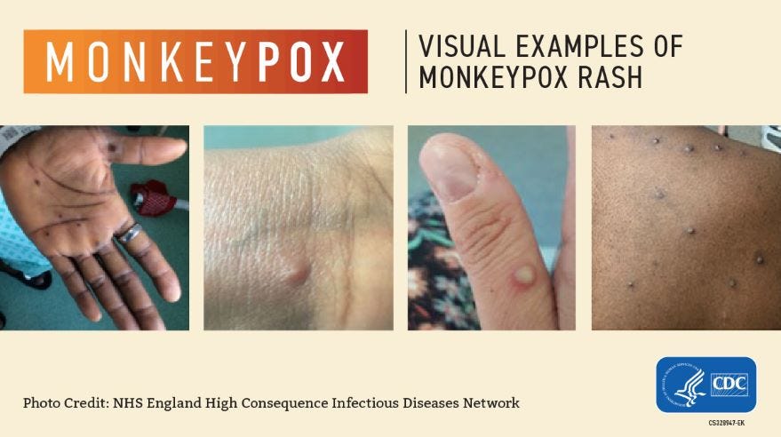 Visual examples of monkeypox lesions 